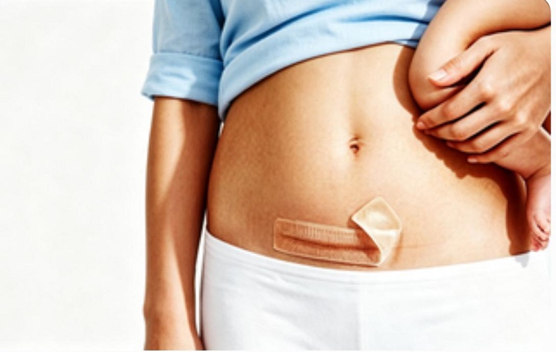 Safe Hormone-Free CmallBio Silicone Scar Patch for Cesarean Section Scar Care