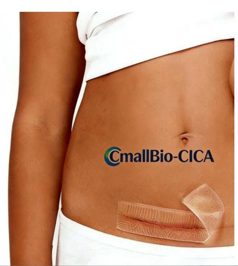 What Scar Patch Is Best for C-Section Hypertrophic Scars? A 2026 Medical-Grade Scar Patch Buying Guide